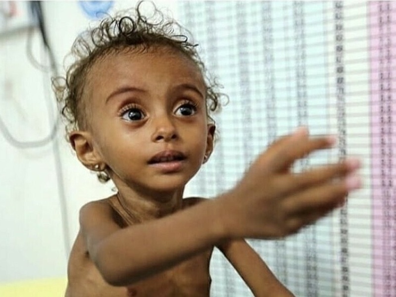 Urgence Malnutrition